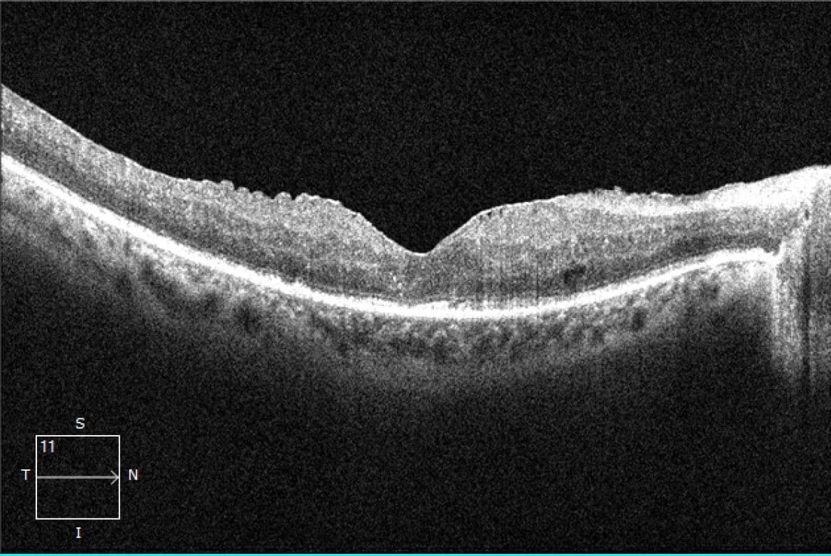 macular pucker pictures