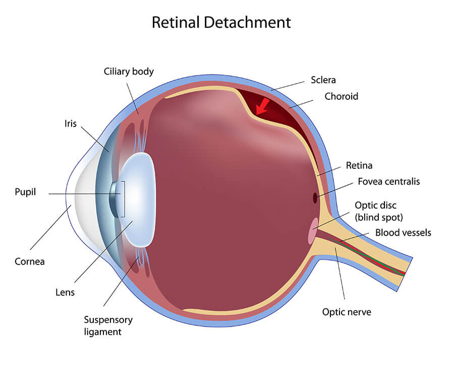 retina tear